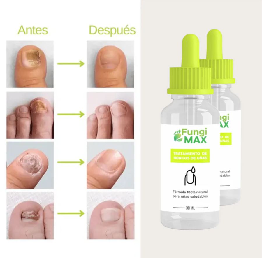 SERUM PARA HONGOS EN UÑA "FUNGIMAX"